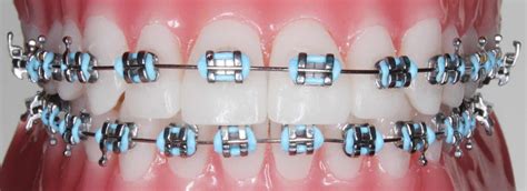 teeth white braces metal brackets|structural steel brackets.